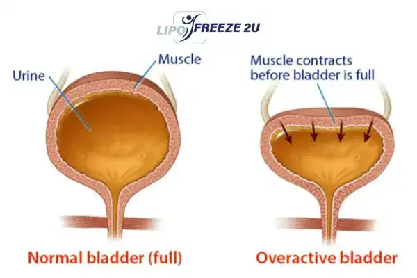 diagram of overactive bladder treatment Harefield