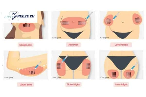 Benefits of Choosing Aqualyx for Fat Reduction Harefield