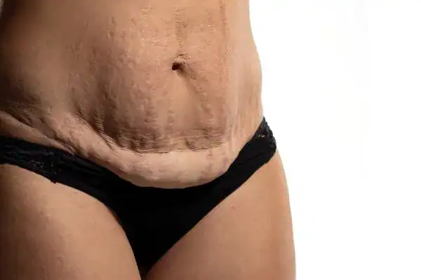 loose skin after weight loss injections Harefield