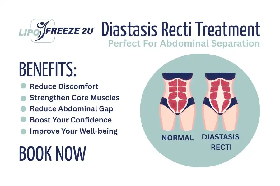 Benefits of body toning treatment Harefield for Diastasis recti