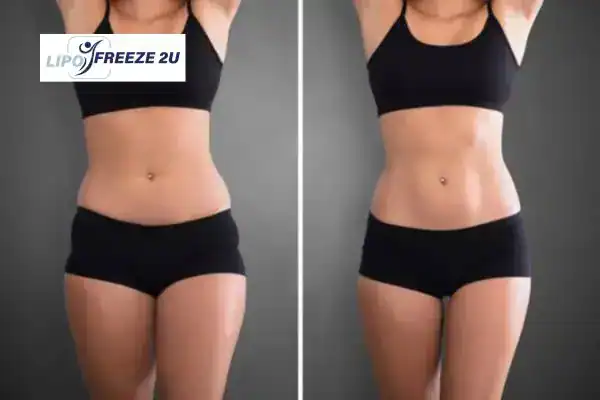 How Can LIPO FREEZE 2U Support Your Post-Pregnancy Body Recovery Harefield?