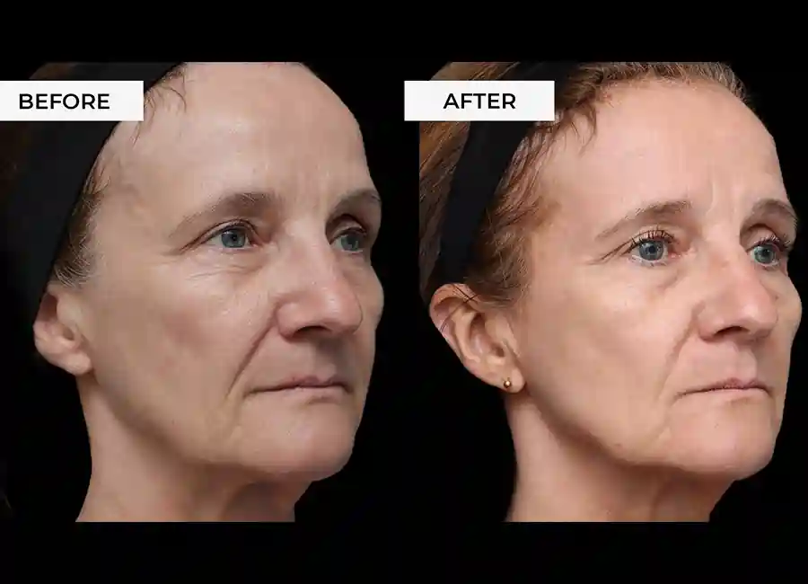 How Many RF Microneedling Sessions Will You Need to See a Difference Harefield?