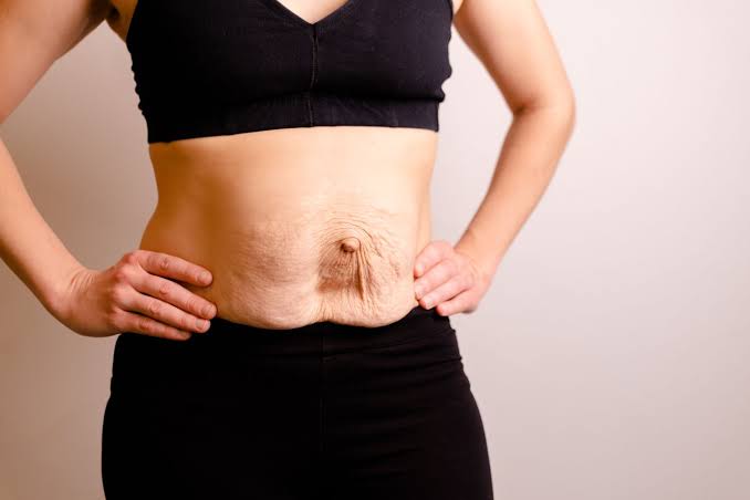 Is Surgery Really the Only Way to Repair Diastasis Recti Harefield?