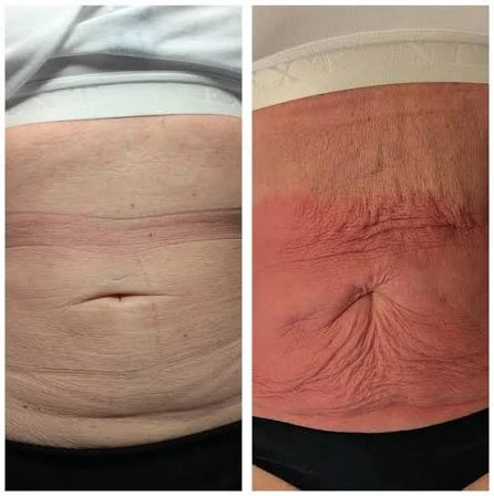 How Does RF Microneedling Improve Crepey, Thin and Uneven Skin Texture Harefield?