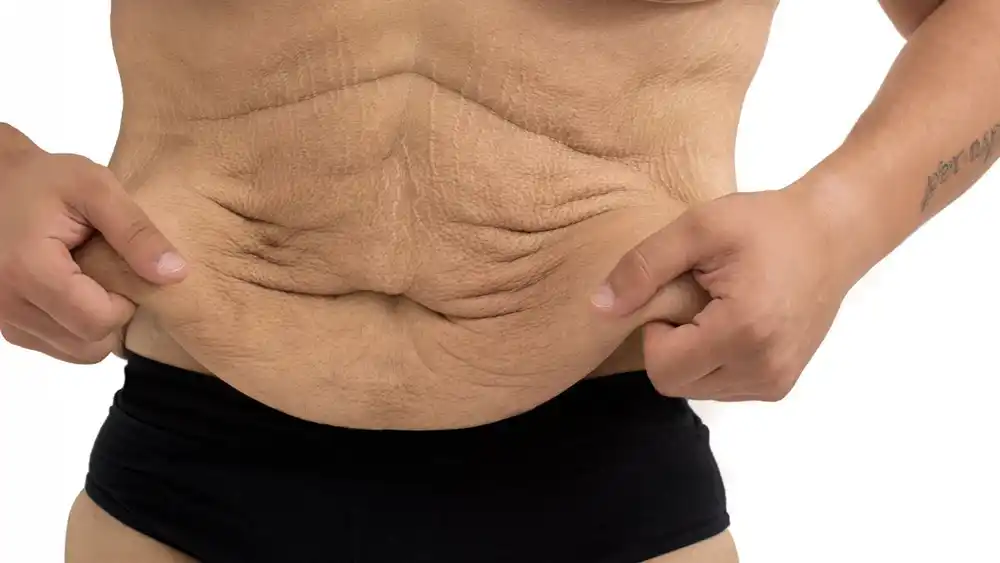 RF Microneedling for Loose Skin: How Can It Help Tighten and Reshape the Skin Harefield?